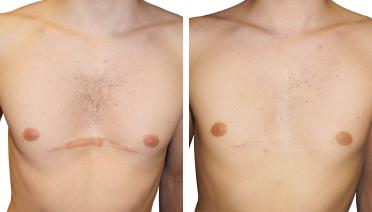 Man - Pectus type 5 - 1 year later - front view
